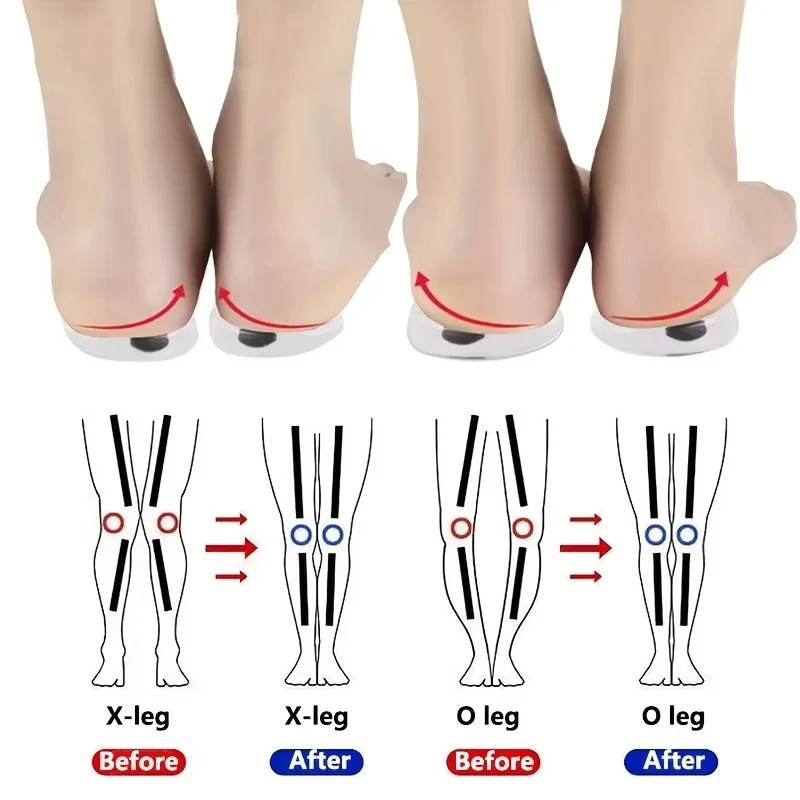 Women Shoes Types - 1 ペア整形外科インソール足 O/X 脚タイプ外反矯正男性女性シリコーンゲル靴インソールマグネットマッサージ靴パッド